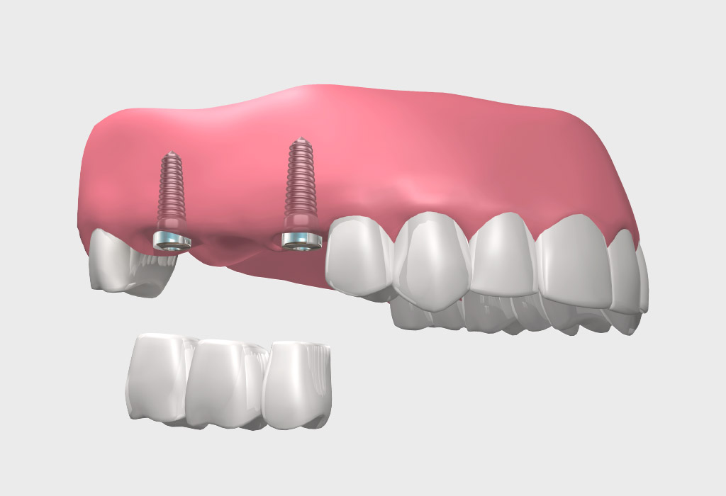 puentes sobre implantes dentales