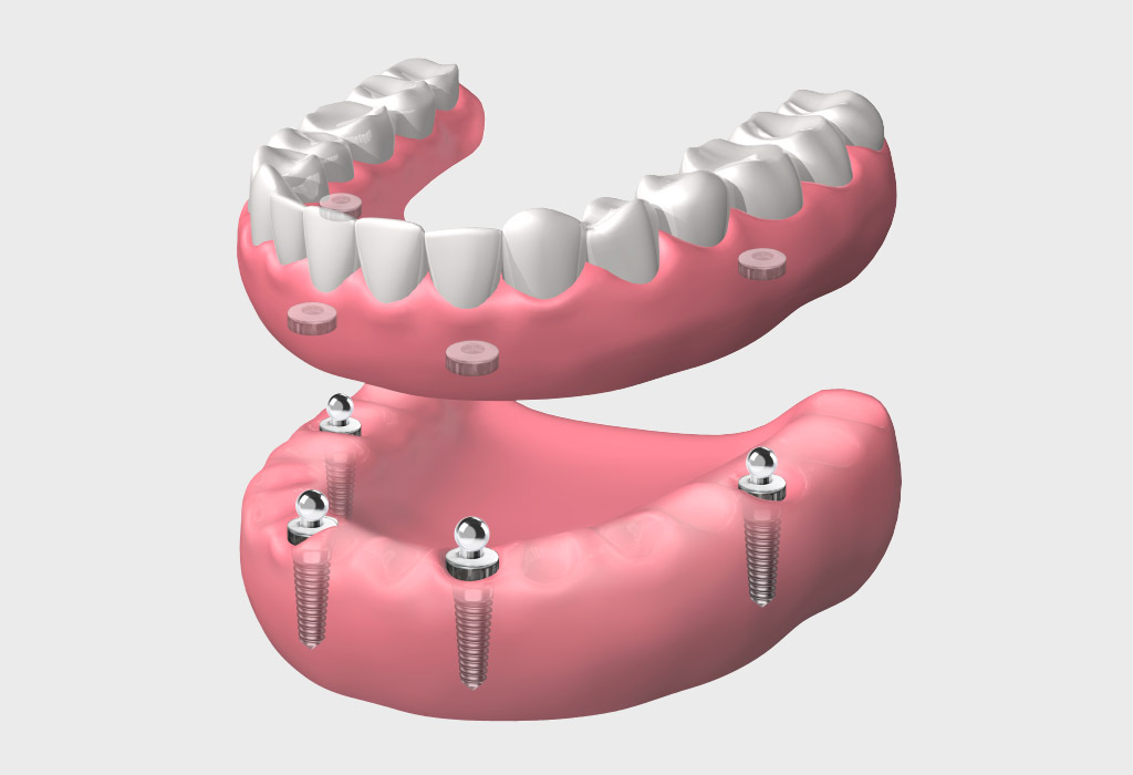 implantes dentales en Nou Barris