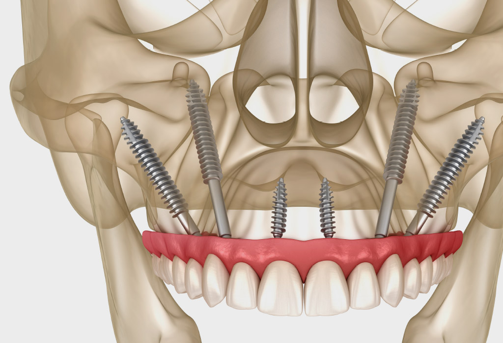 implantes dentales en Nou Barris