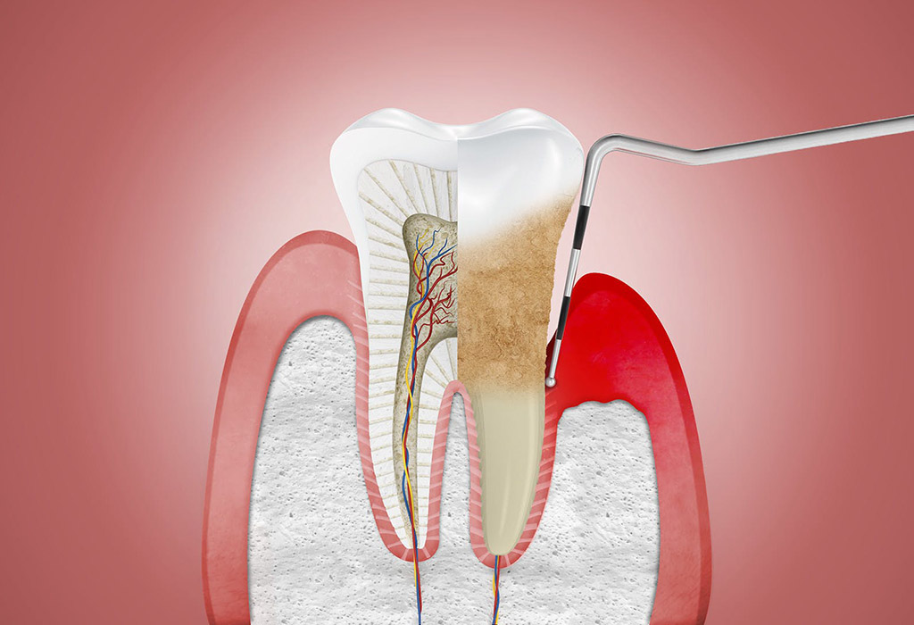 periodontitis y gingivitis en Nou Barris